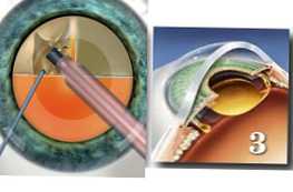 Чим краще видаляти катаракту лазером або ультразвуком
