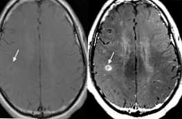 Jak se liší od MRI bez kontrastu od MRI s kontrastem