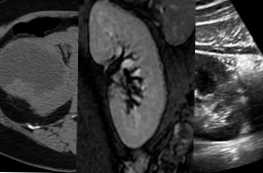 Kaj je boljše in zanesljivejše od CT, MRI ali ultrazvoka ledvic?