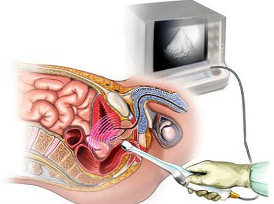 transrektalni ultrazvok prostate