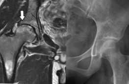 Apa yang lebih baik dari MRI atau X-ray dari sendi panggul