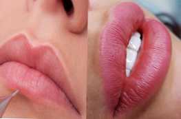 Apa tato bibir atau asam hialuronat terbaik?