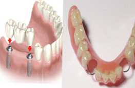 Který je lepší zvolit zubní můstek nebo snímatelné protézy?