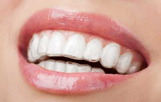 Inviseline - metode untuk memperbaiki maloklusi tanpa kawat gigi