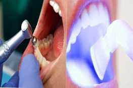 Яка процедура краще чистка або відбілювання зубів?