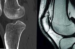 Яка процедура краще КТ або МРТ колінного суглоба?