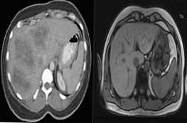 Apa prosedur terbaik untuk CT atau MRI hati?