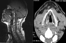 Aký je najlepší postup pre MRI alebo CT hrtanu?
