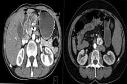 Jaká je nejlepší pankreatická diagnostická technika pro MRI nebo CT?