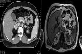 Ktorá metóda je lepšia a účinnejšia ako CT alebo MRI nadobličiek