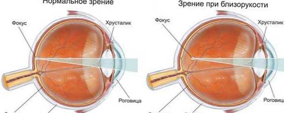Rozdiel medzi krátkozrakosťou a ďalekozrakosťou