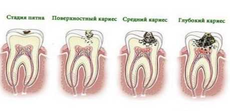 Rozdiel medzi zubným kazom a pulpitídou