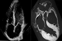 Srdeční ultrazvuk nebo srdeční MRI srovnání postupů a které je lepší