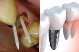 Jaka jest różnica między szpilką a implantem i która jest lepsza?