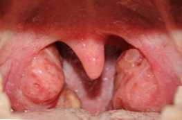 Bagaimana faringitis berbeda dari deskripsi dan perbedaan radang tenggorokan
