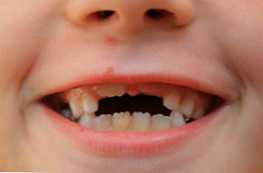 По какво се различават млечните зъби от кътниците