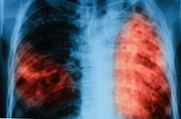 Koja je razlika između karakteristika bolesti upale pluća i tuberkuloze