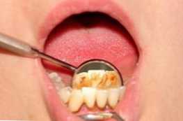 Чим зубний наліт відрізняється від зубного каменю