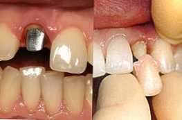 Jaký je nejlepší špendlík nebo korunka na vlastnostech a rozdílech zubů