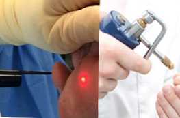 Apa penghapusan kutil terbaik dengan laser atau nitrogen?