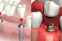 Кое е по-добре да изберете зъбен мост или имплант?