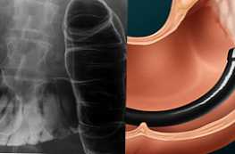 Primerjava irrigoskopije ali kolonoskopije debelega črevesa in katera je boljša