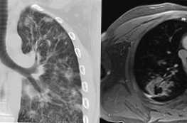 CT a MRI pľúcnych rozdielov a čo je lepšie