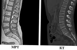 MRI a CT páteře - jak se liší a co je lepší