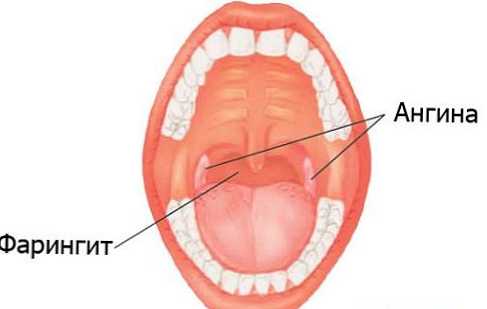 Perbedaan antara tonsilitis dan faringitis