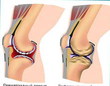 Perbedaan antara artritis dan arthrosis