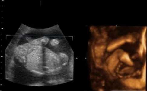 Razlika med ultrazvokom in 3D ultrazvokom
