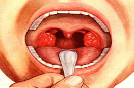 Tonsillitis és tonsillitis - különböznek egymástól