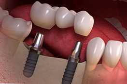 У чому різниця між імплантацією і протезуванням зубів?