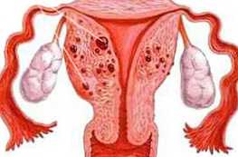 Kakšna je razlika med adenomiozo in endometriozo